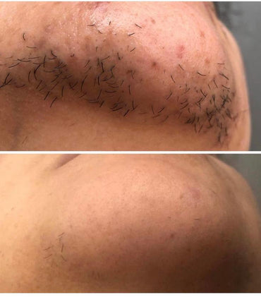 Unlimited Laser hair removal