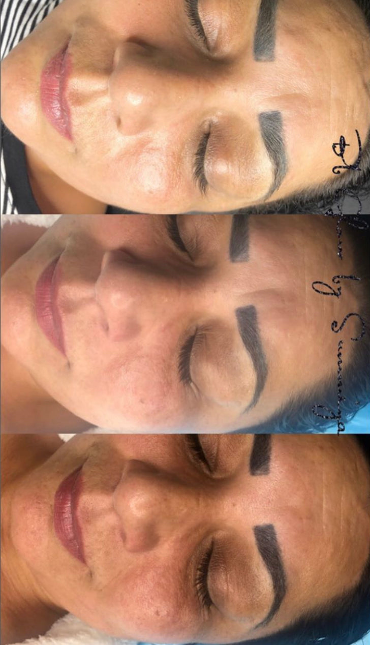 BB Glow Treatment with LED light therapy