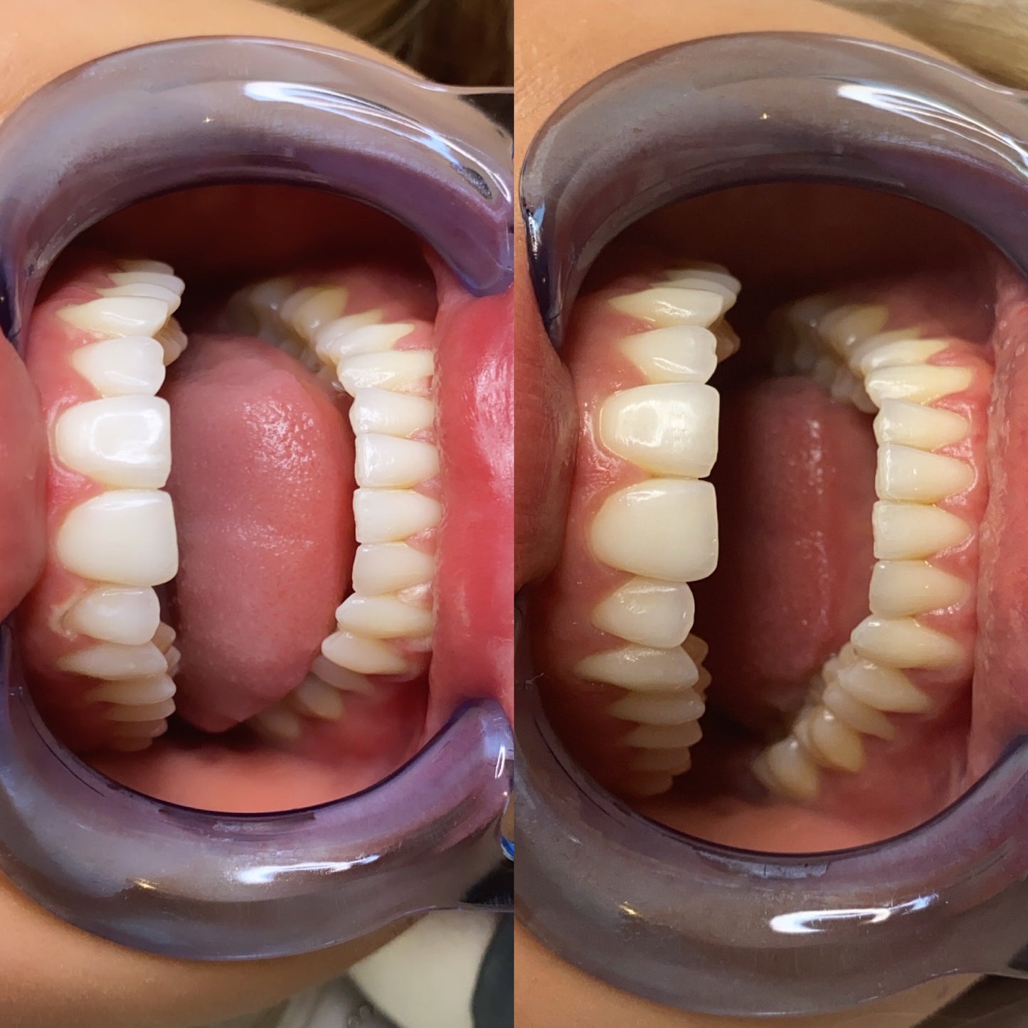Teeth whitening