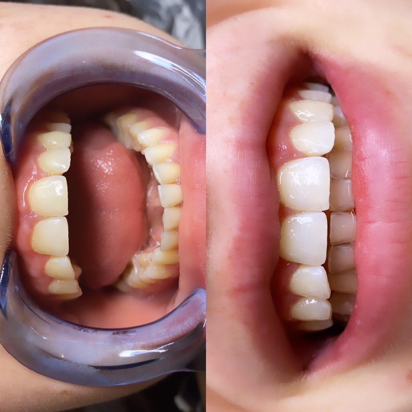 Teeth whitening