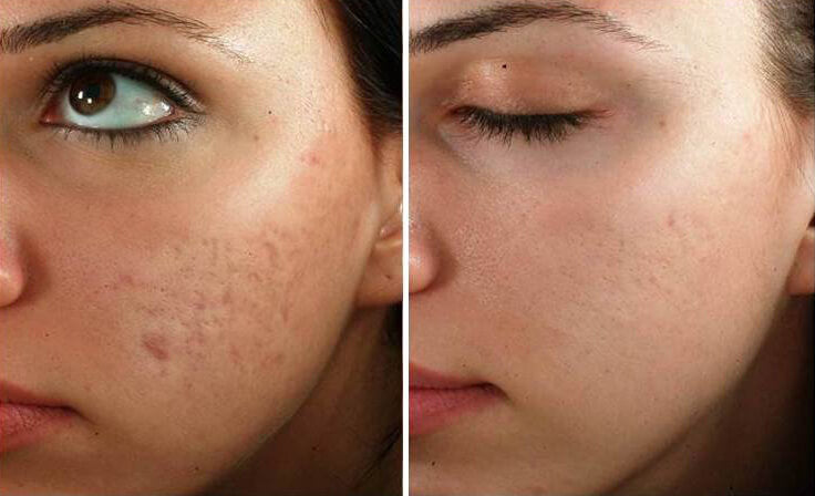 Microneedling