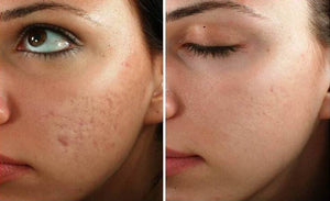 Microneedling + LED light therapy