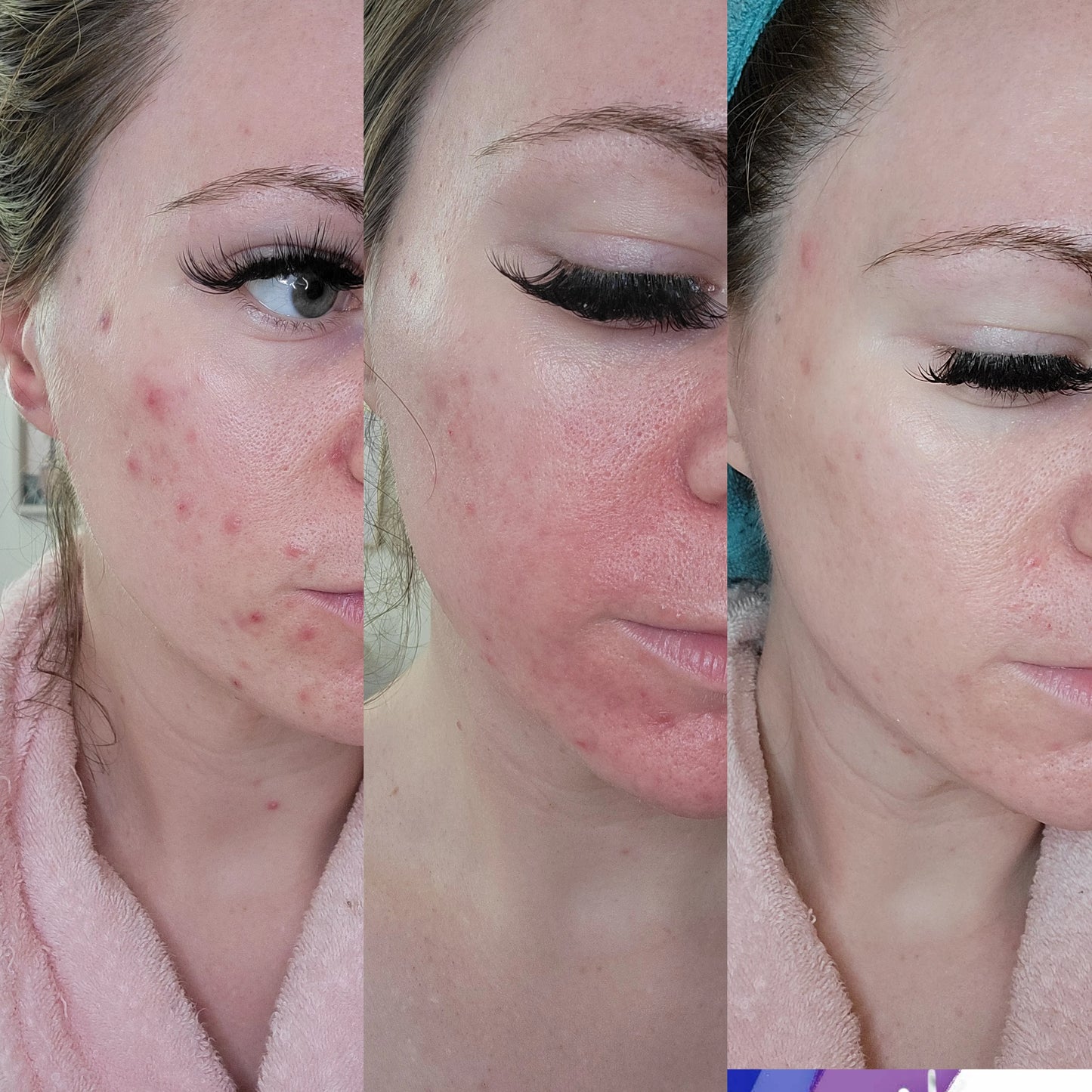 Microneedling