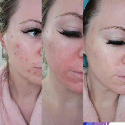 Microneedling