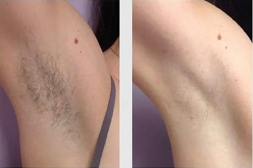 Unlimited Laser hair removal