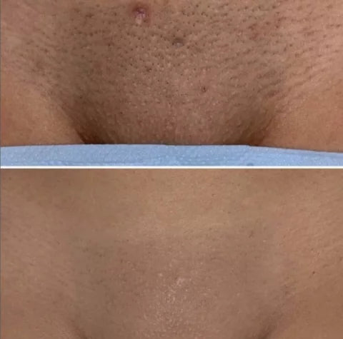 Unlimited Laser hair removal