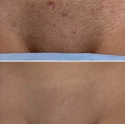 Unlimited Laser hair removal