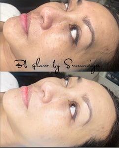 BB Glow Treatment with LED light therapy