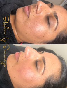 BB Glow Treatment with LED light therapy