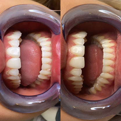 Teeth whitening