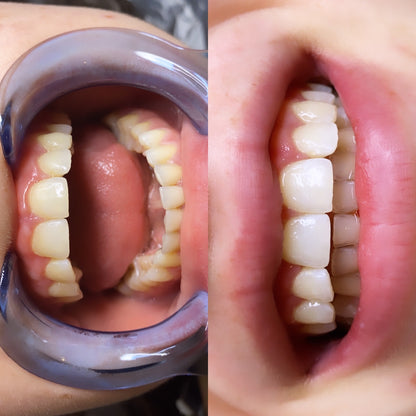 Teeth whitening